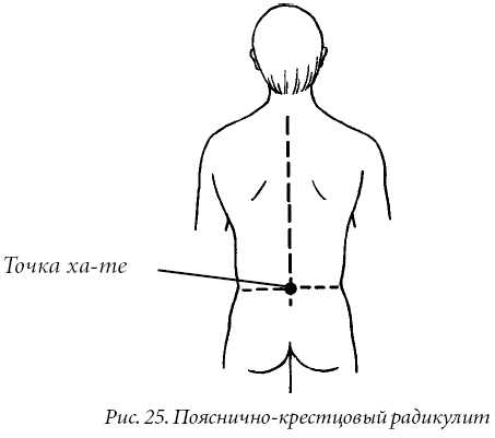 Шейный радикулит (прострел).